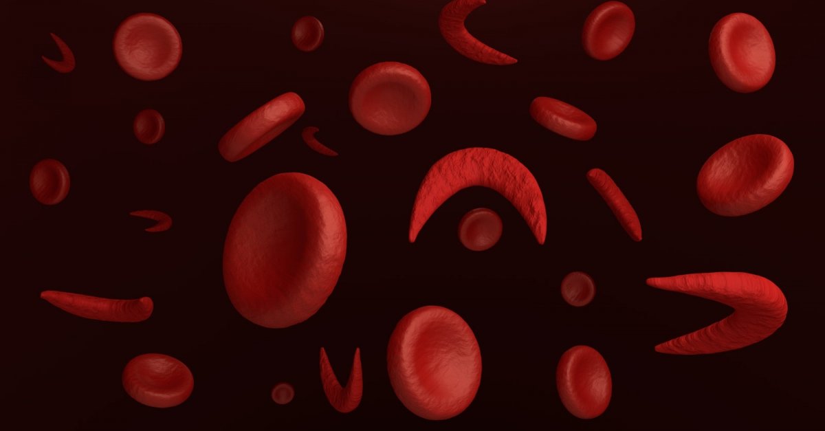 Anemia sierpowatokrwinkowa